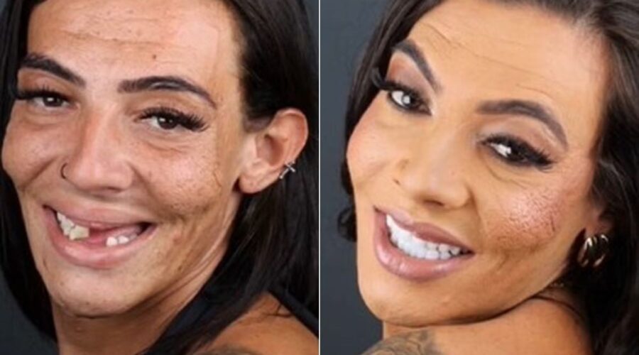 Ex-Casal Maloka passa por cirurgia nos lábios após ser agredida por seguranças; veja antes e depois