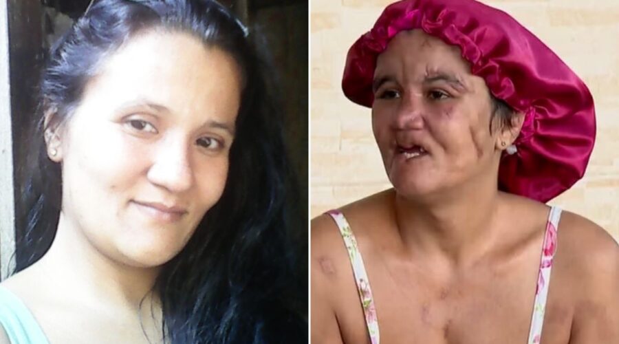 Mulher que teve couro cabeludo e dentes arrancados pelo companheiro busca recomeço: 'Um pouco mais feliz'