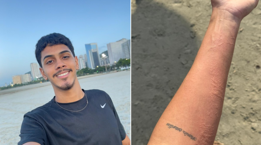 Jovem sofre queimadura de água viva no braço e quer tatuar animal após 'experiência única' no litoral de SP