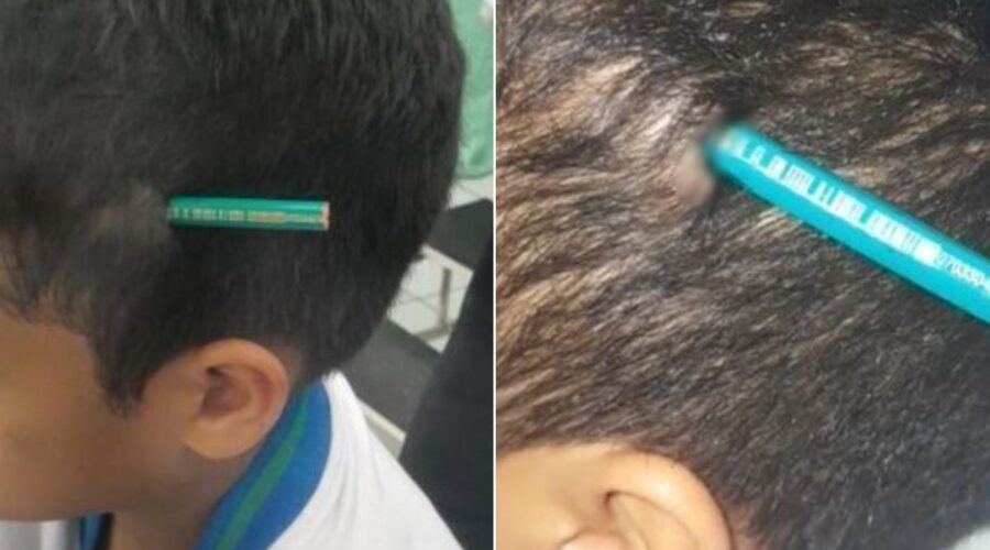 Neurologista alerta para riscos após menino de 9 anos ficar com lápis cravado na cabeça no litoral de SP