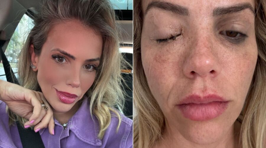 Apresentadora é infectada por bactéria com poder de cegar; conheça a celulite ocular