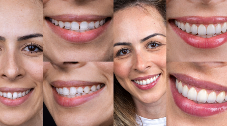 De Santos para o mundo: sorrisos naturais com lentes e implantes