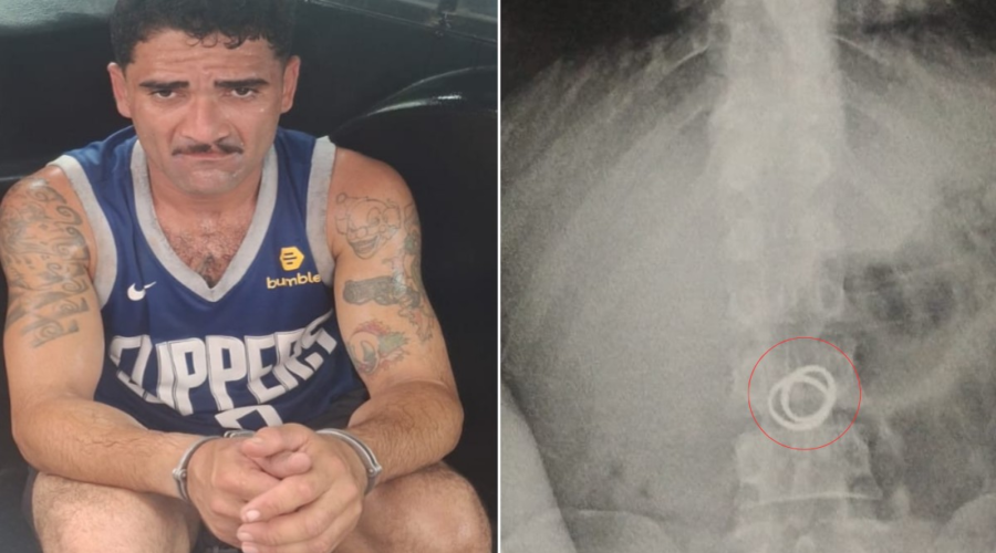 Raio-X revela alianças engolidas por criminoso preso no litoral de SP; VEJA