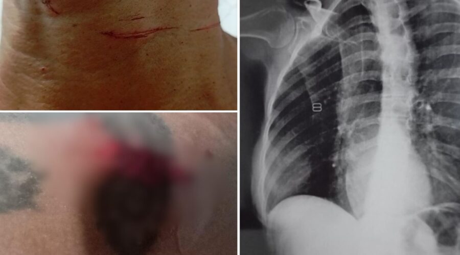 Mulher se joga da moto após ser atingida por linha com cerol e fratura costelas: 'Teria morrido'