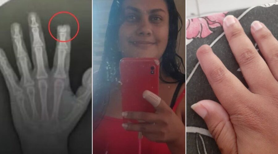 Mulher que teve dedo arrancado a dentadas durante briga no Carnaval diz que folia nunca será a mesma