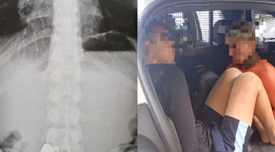 Ladrão engole correntinhas de ouro após roubo em Guarujá, SP, e peças aparecem em raio-X