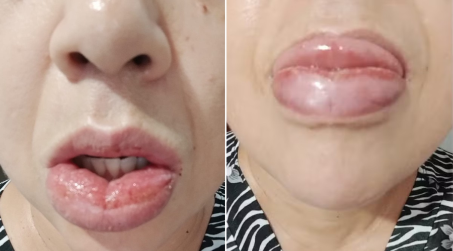 Mulher que ficou com boca inchada após usar creme dental perde processo contra Colgate; entenda