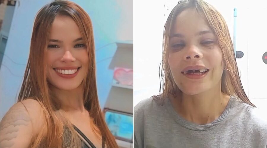 Jovem perde cinco dentes em acidente de moto e sonha com prótese: 'Foi como perder a minha identidade'
