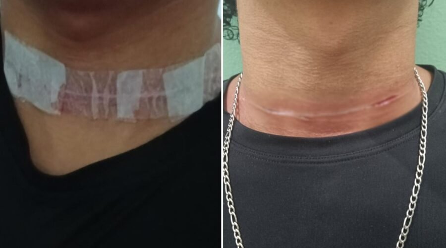 Motociclista de 19 anos tem pescoço cortado por linha de pipa no interior de SP