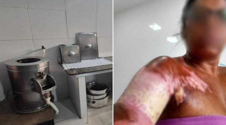 Restaurante é condenado a indenizar ex-funcionária que se queimou fritando batatas; valor pode passar de R$ 90 mil